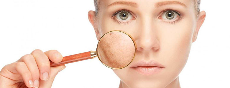 Anti - Pigmentation Treatment