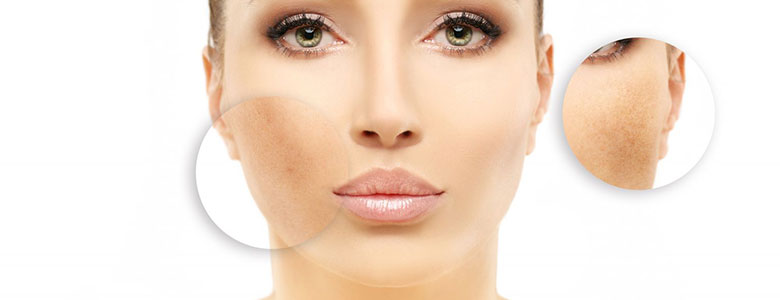 Clarifying Hyperpigmentation Peel 