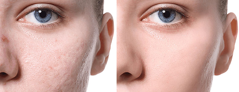Dermo Peel Expert- Acne Scars – Brightening Treatment