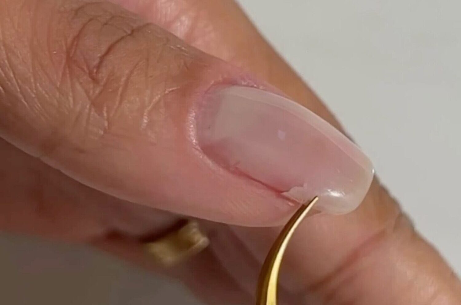 Single Nail Reconstruction