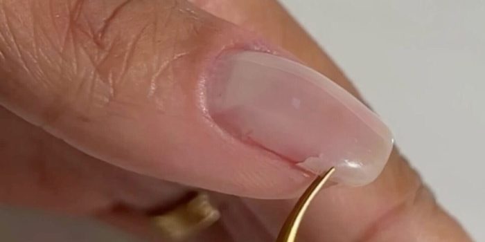 Single Nail Reconstruction